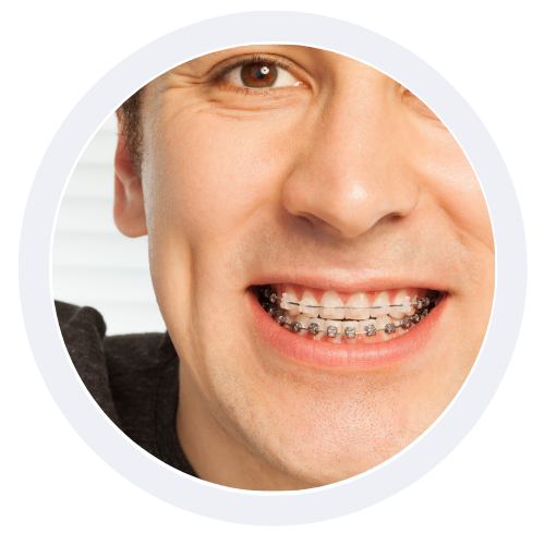 blanqueamiento dental Lima