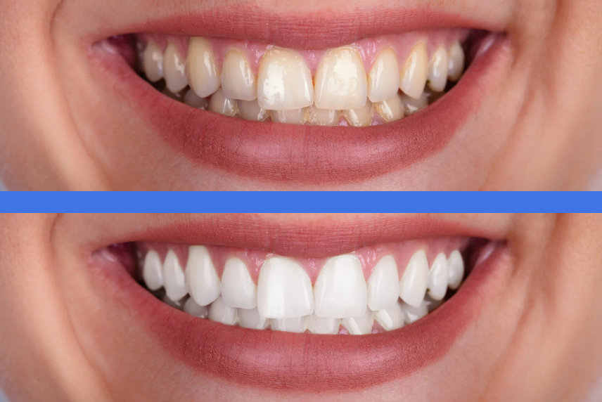 kit blanqueamiento dental